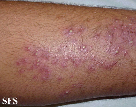 Folliculitis | Definition and Patient Education