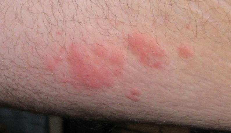 Raised bumpy, itchy rash on back of thigh and upper legs ...